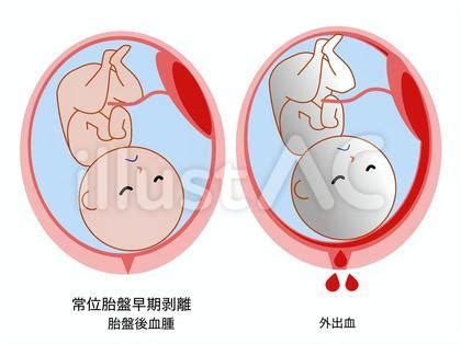 胎盤剝離方式|了解胎盤早期剝離